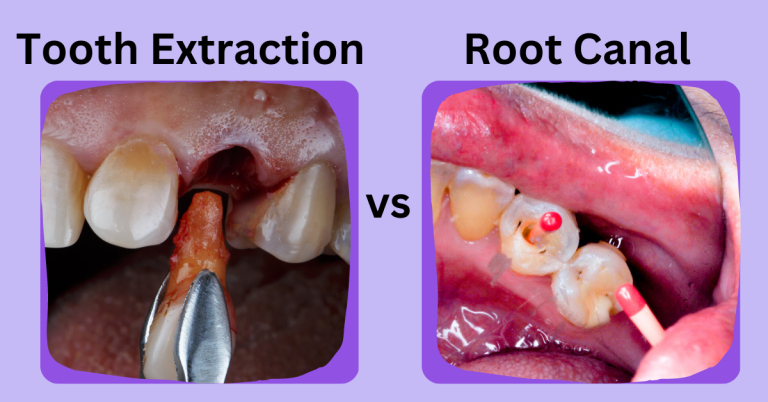 Tooth Extraction vs. Root Canal: Making the Right Dental Decision