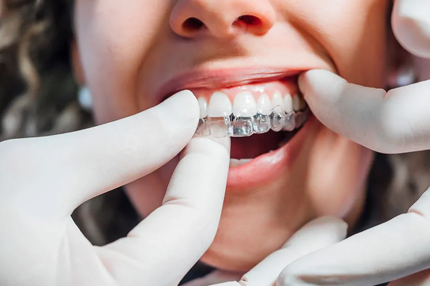 Clear Aligner Therapy