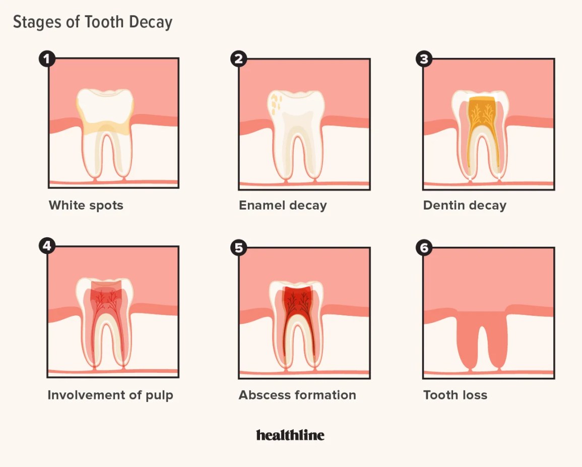 Understanding the Cavity Formation Process and How to Prevent It