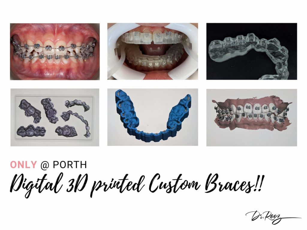 Custom 3D-Printed Braces: Revolutionizing Orthodontic Treatment
