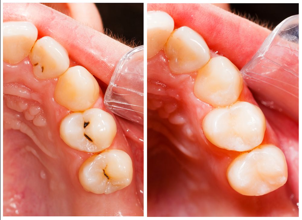Advancements in Tooth-Colored Fillings for a Natural-Looking Smile
