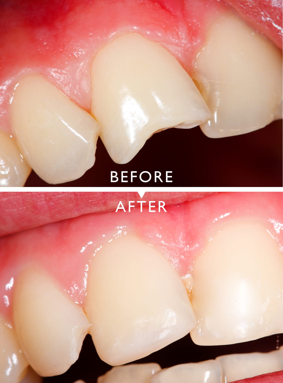 Cracked or Chipped Teeth: Immediate Steps to Avoid Long-Term Damage