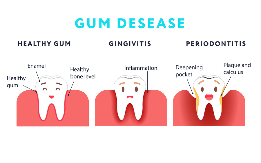Gum Disease: Early Signs and Prevention Strategies