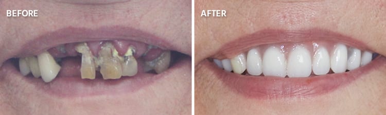 Full Mouth Reconstruction: What to Expect from Start to Finish