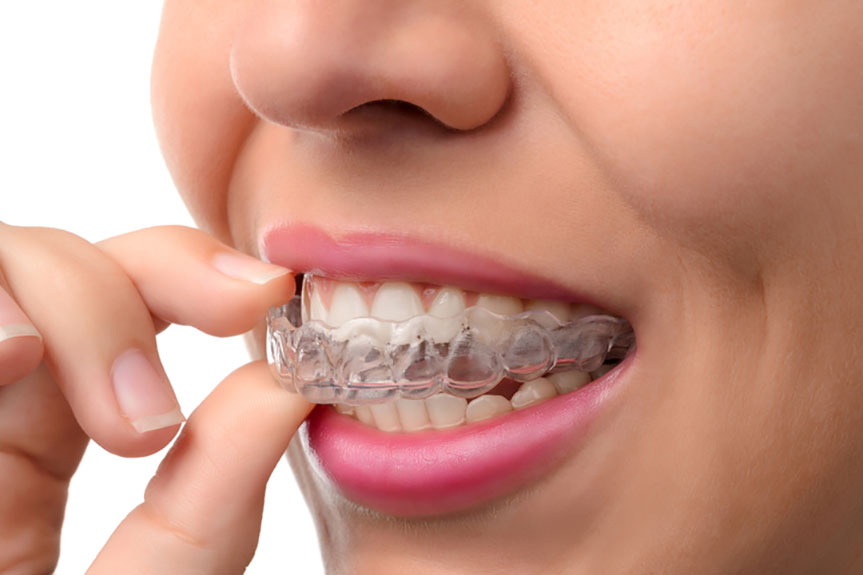 Invisible Braces: The Future of Teeth Straightening