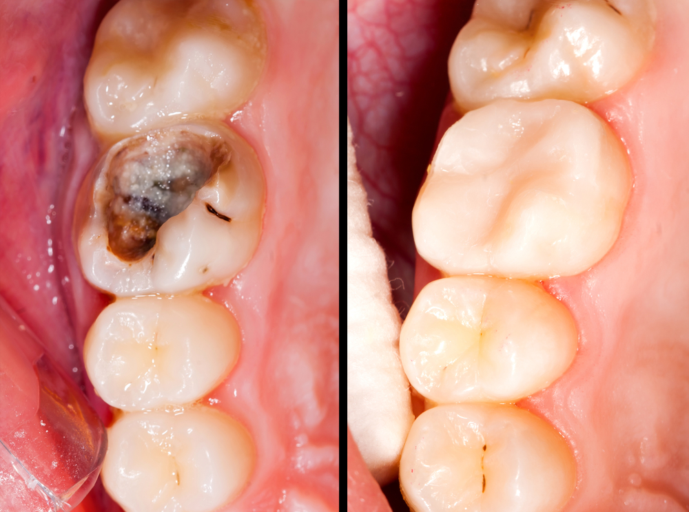 You are currently viewing Latest Advances in Tooth Decay Prevention: A Deep Dive