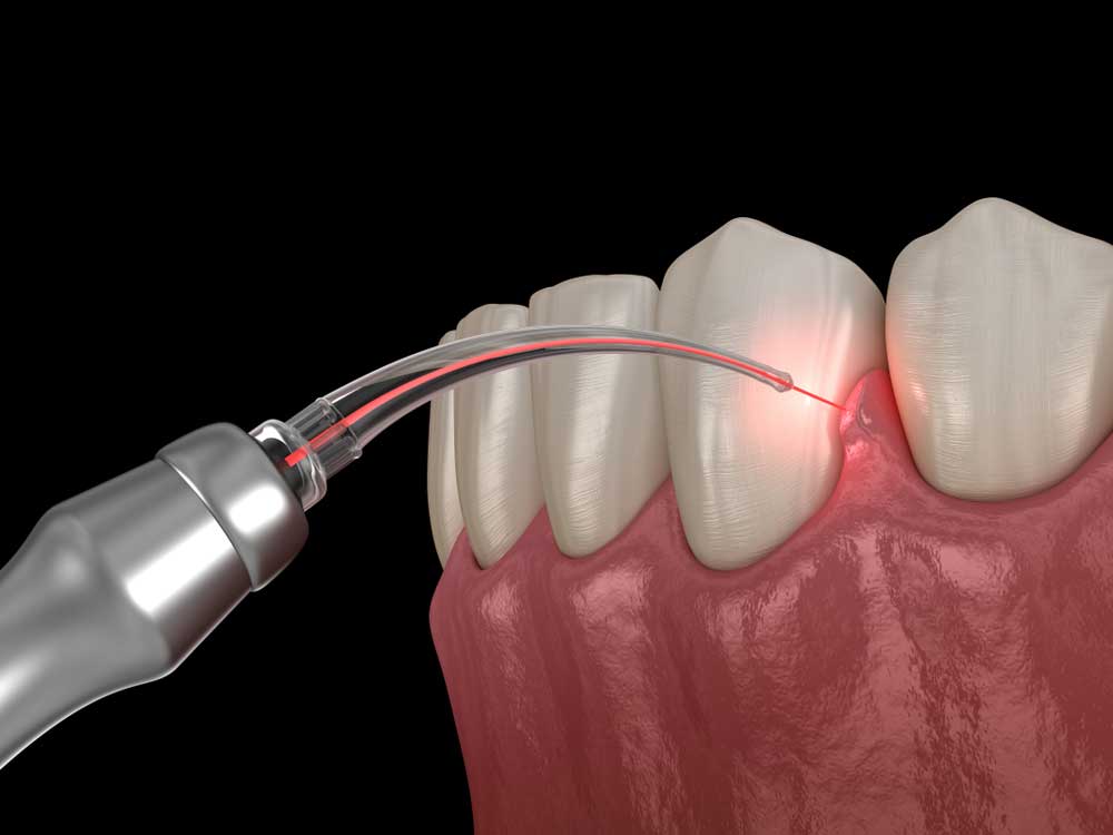 Minimally Invasive Dental Treatments: Laser Dentistry