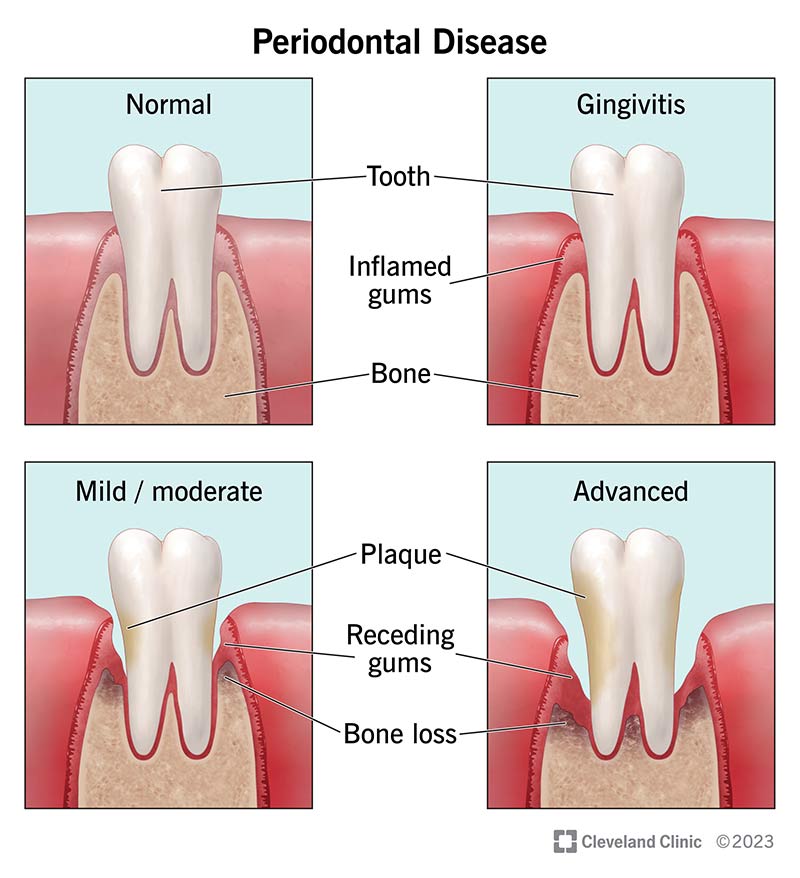 Post-Periodontal Treatment Care: Ensuring Long-Term Gum Health.