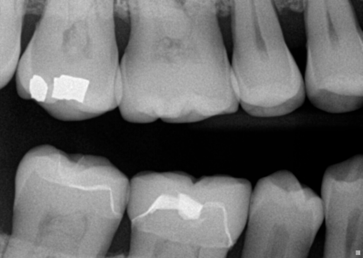 How Often Should You Get Dental X-rays?