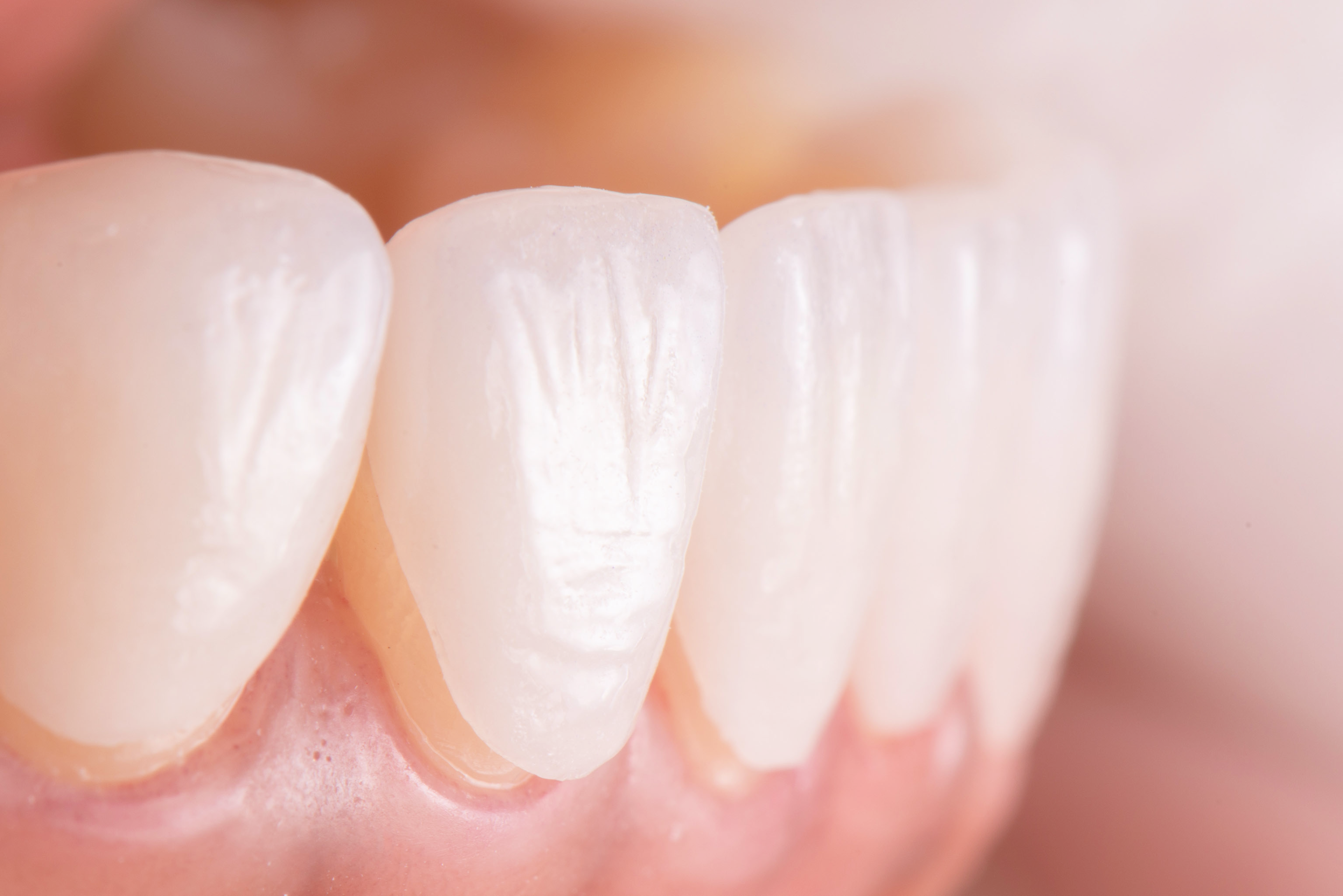 Veneers: A Solution to Chipped and Discolored Teeth?