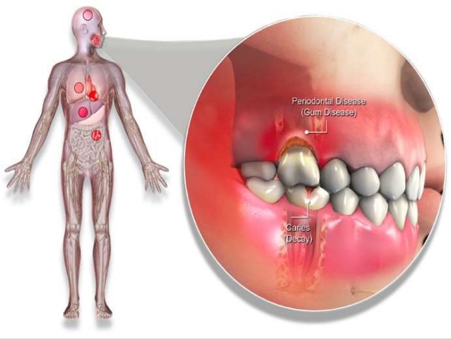 Why Healthy Gums Matter: Systemic Health Links to Periodontitis.