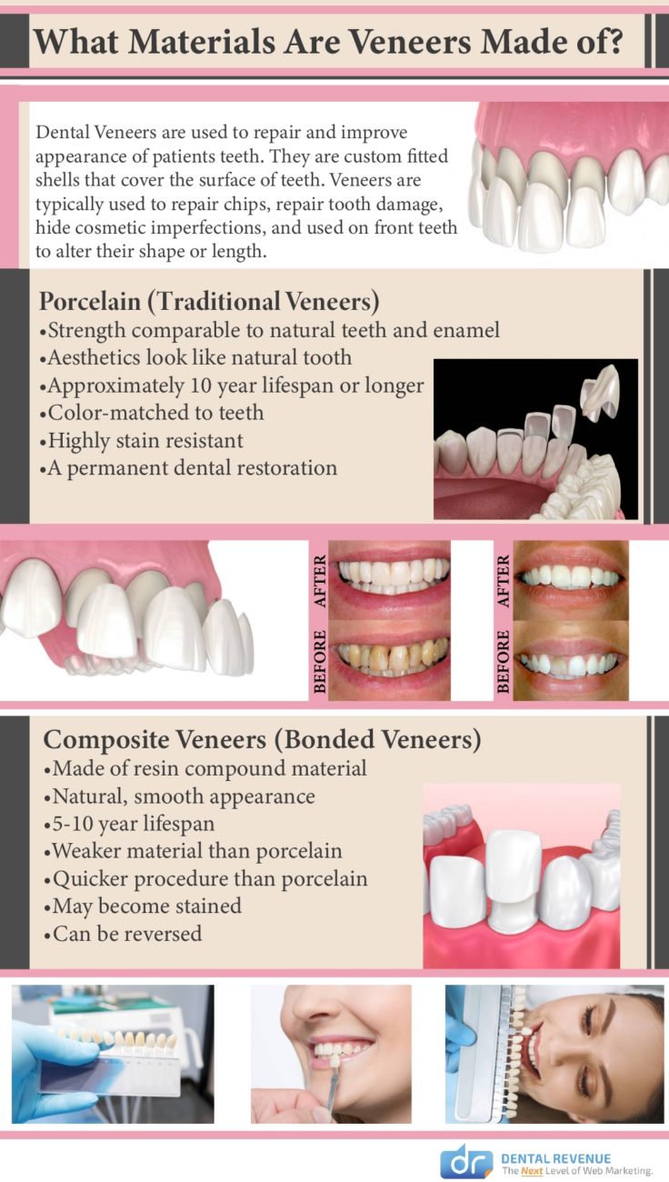 Longevity of Dental Veneers: What to Expect and How to Care.