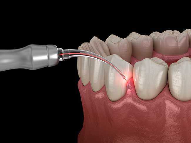 LANAP Laser Treatment: A Modern Approach to Gum Disease.