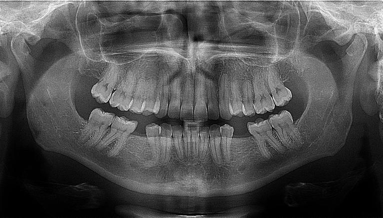 Why Your Dentist Might Recommend a Panoramic X-ray.