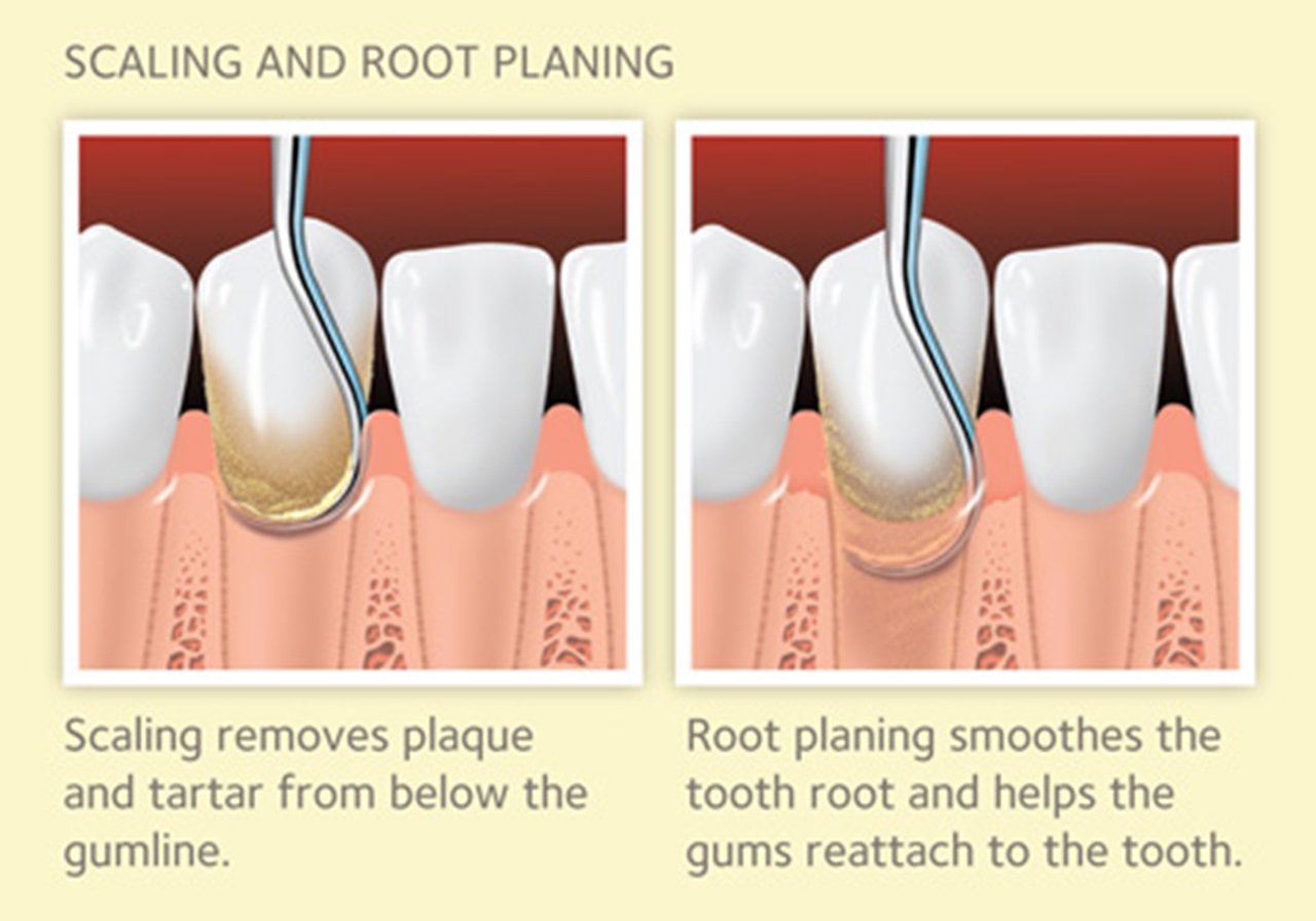 The Importance of Scaling and Root Planing in Periodontal Health.