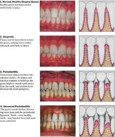 Understanding Gum Disease: Stages and Treatment Options.