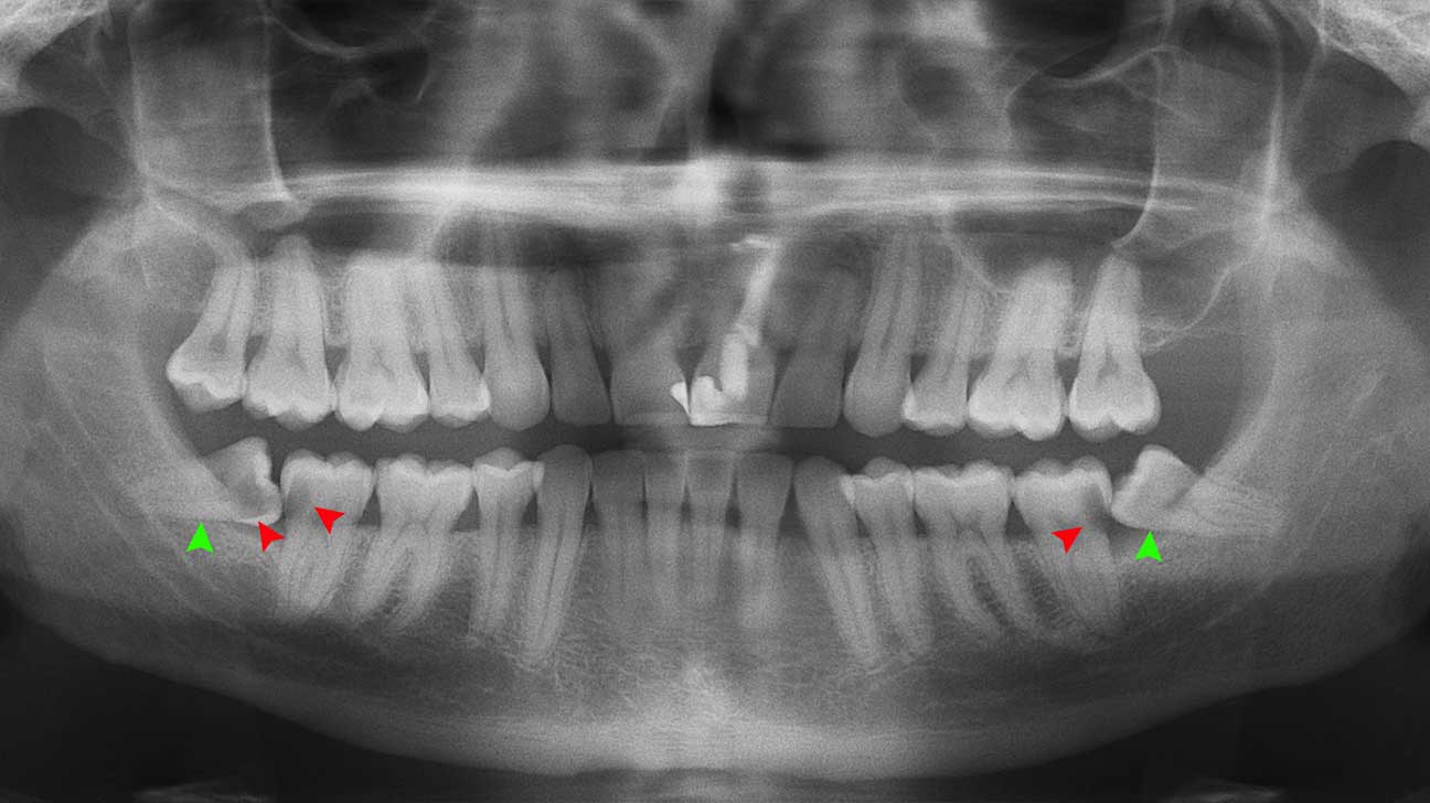Impacted Wisdom Teeth: Symptoms and Treatment Options