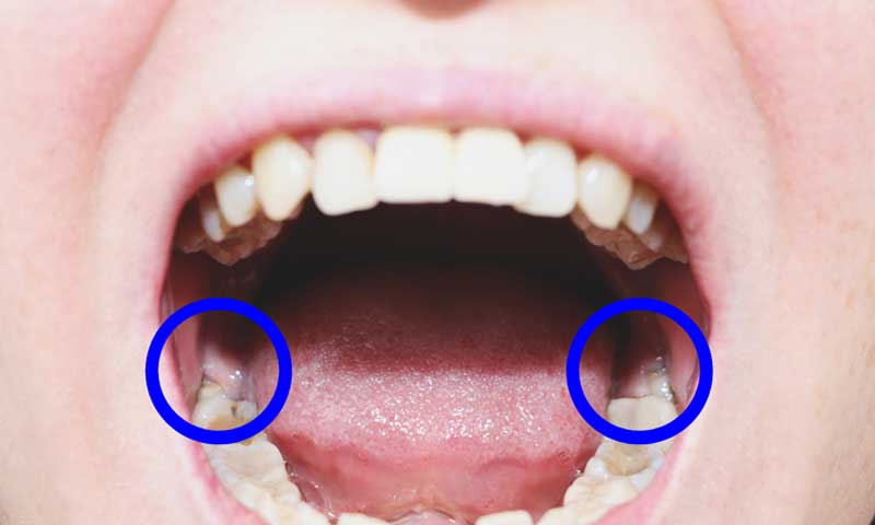 Impacted Wisdom Teeth Symptoms And Treatment Options Smilesage