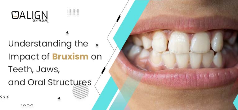 Understanding Bruxism: Causes, Symptoms, and Impact