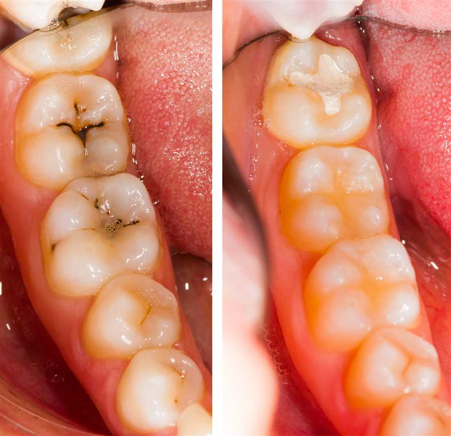Composite Fillings: Natural-Looking Solutions for Decayed Teeth