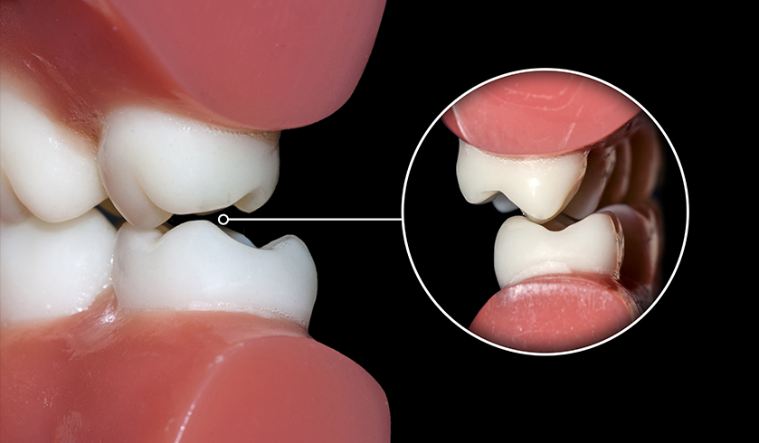 The Long-term Effects of Untreated Teeth Grinding