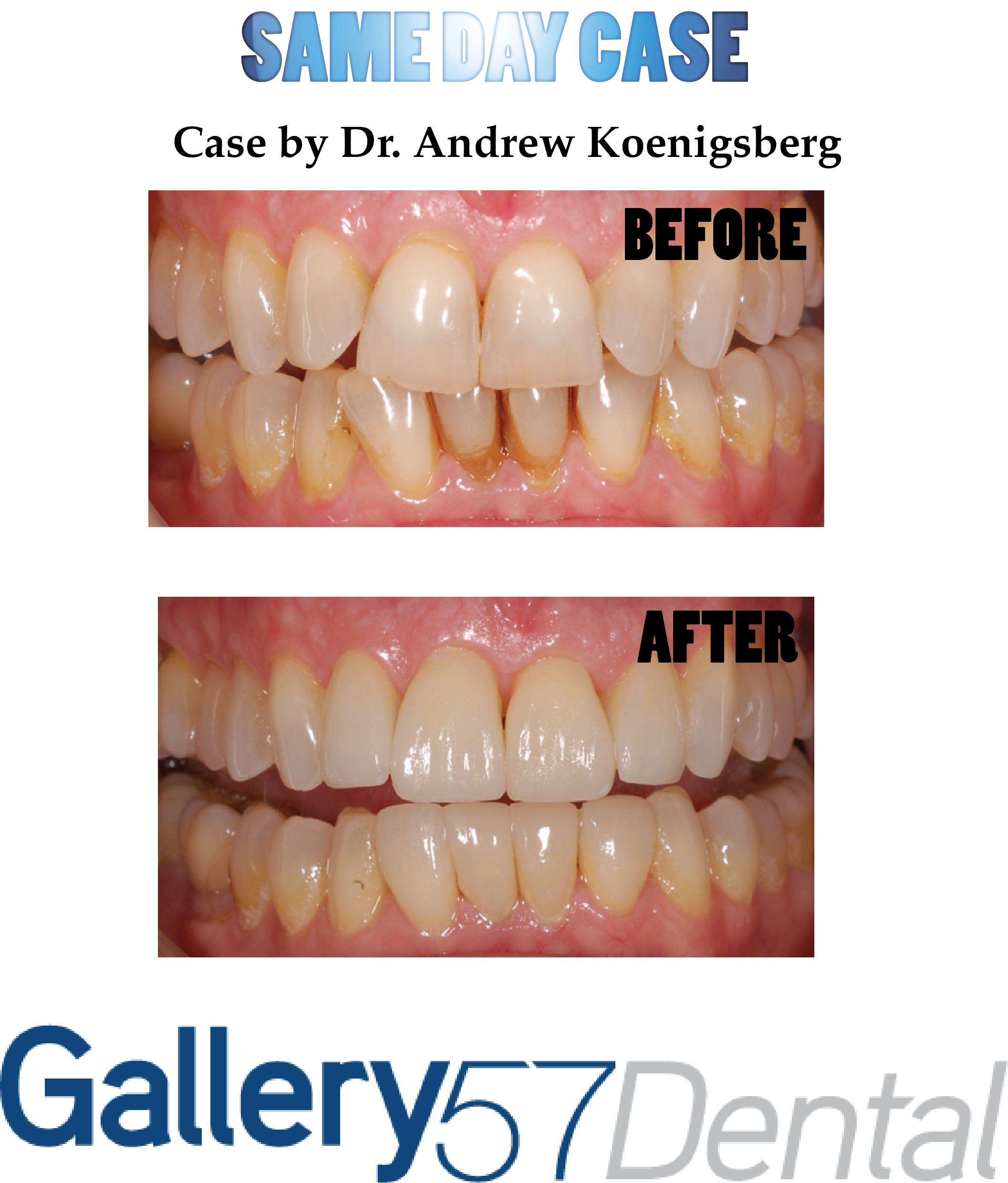 Achieving the Perfect Smile with Invisalign