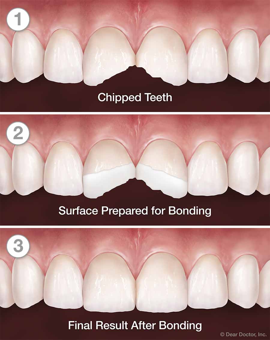 Dental Bonding: A Quick Solution for Chipped Teeth