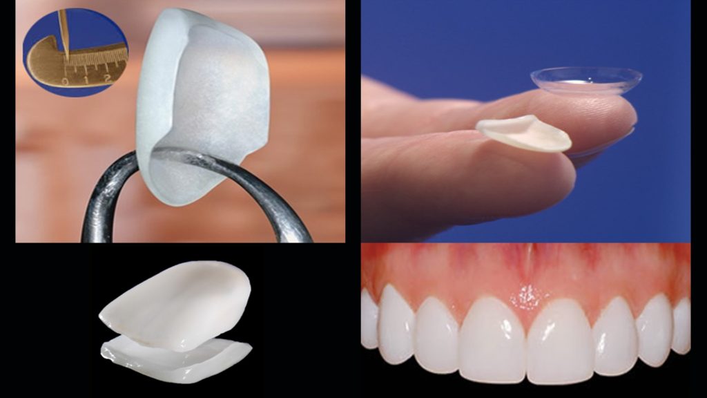 Porcelain Veneers: Process, Benefits, and Care