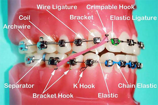 Dental Accessories for Braces: A Comprehensive Guide
