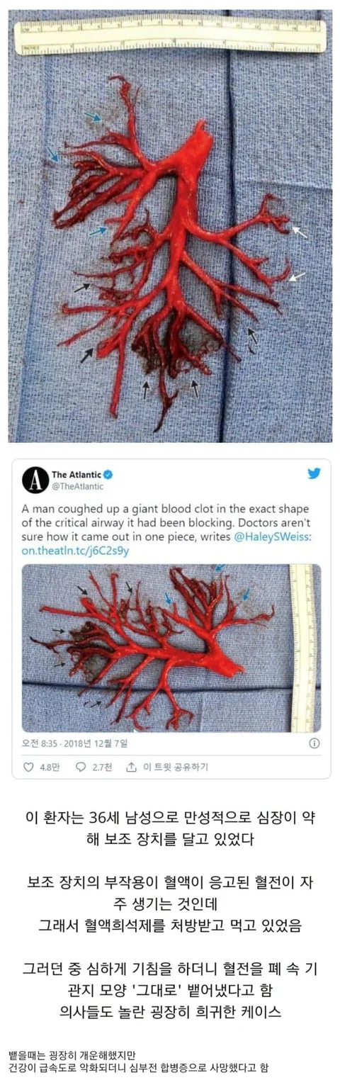 (혐) 기침을 했더니 혈전이 기관지 모양 그대로 나옴