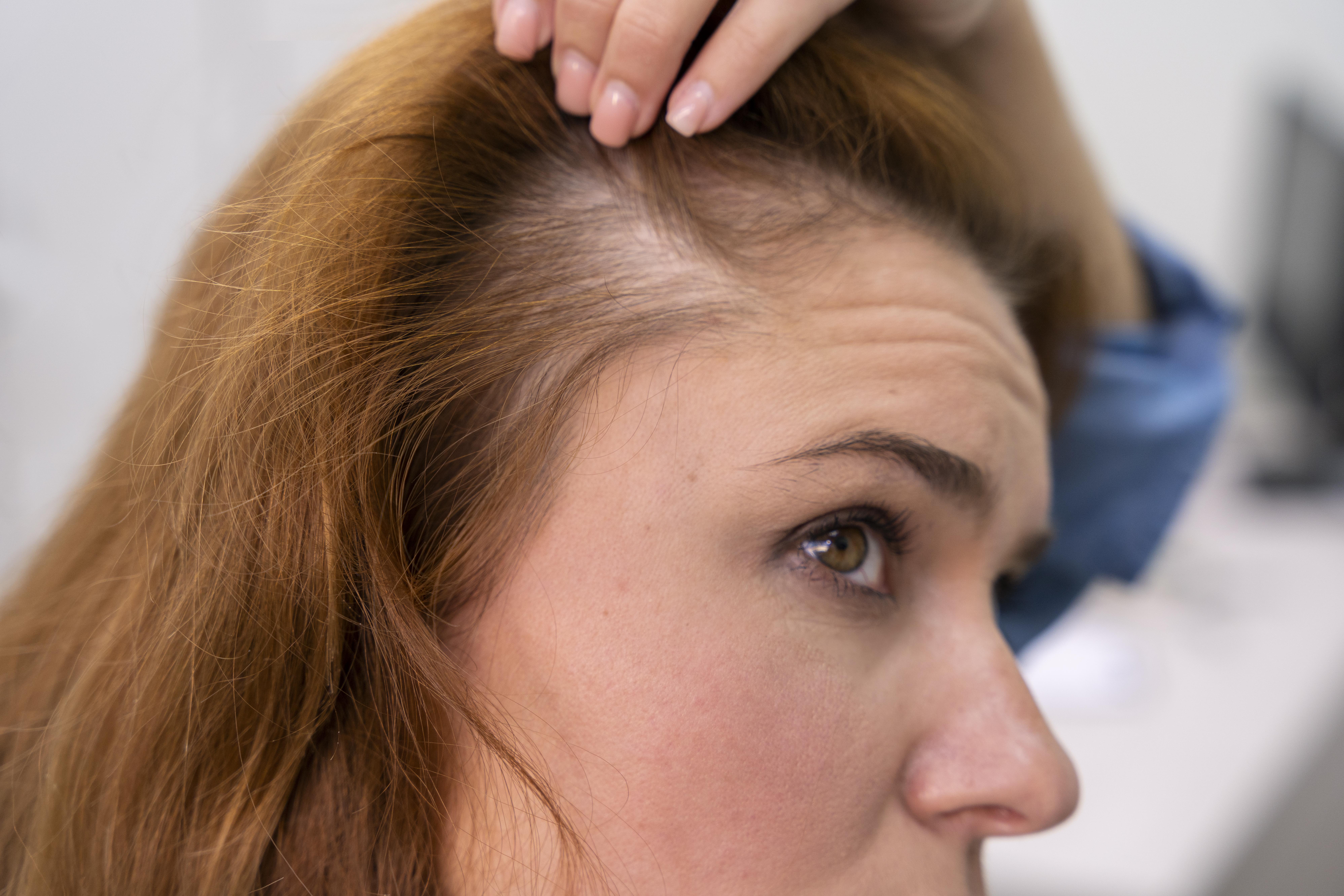 Woman receiving hair loss treatment