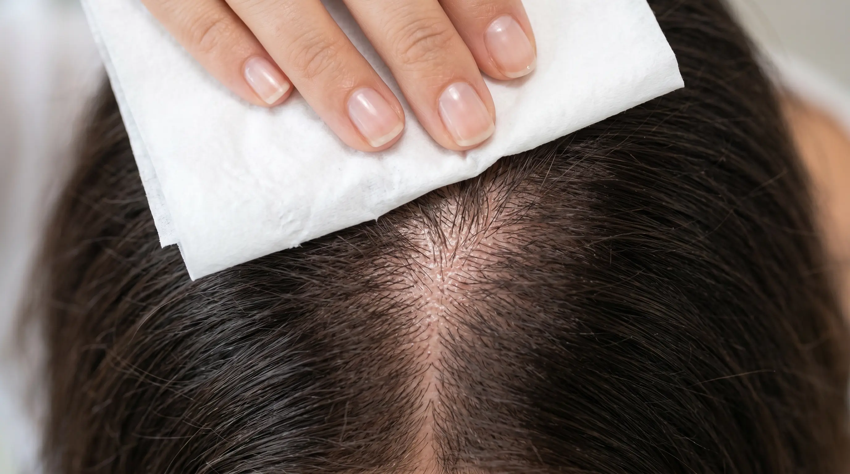 Scalp baseline